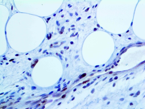 IHC of MDM2 on a FFPE Liposarcoma Tissue